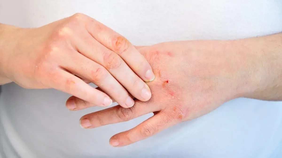 Dấu hiệu mắc bệnh viêm da chính là vùng tiếp xúc xuất hiện tình trạng ngứa, mẩn đỏ và nhiễm trùng